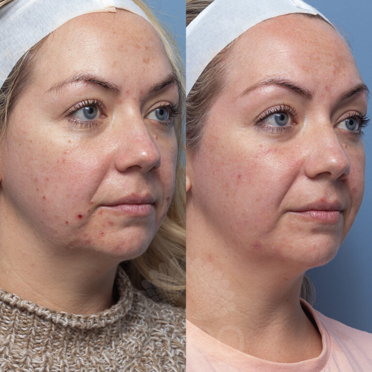 Hydra Facial | Coco Skin Clinic