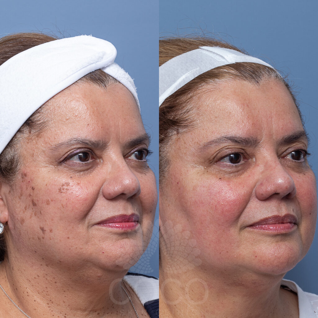 Pro Laser | Coco Skin Clinic