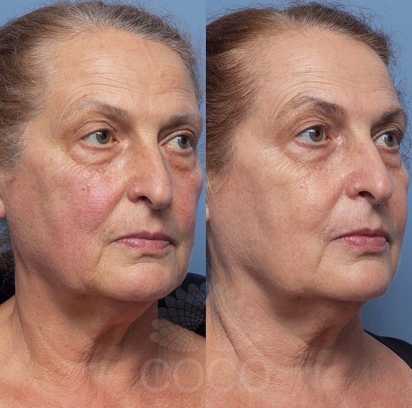 Coco Refresh | Coco Skin Clinic