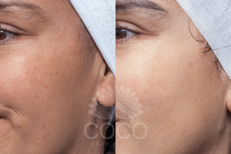 COCO Luxe Medi-Facial