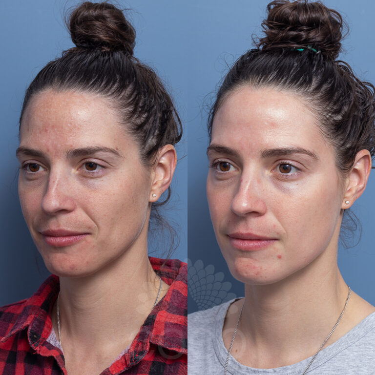 Depigmenting treatment for melasma