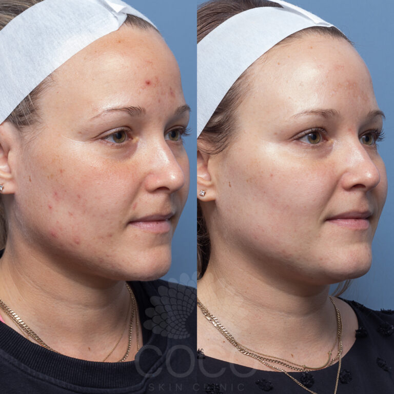 skin is treated with targeted serums and LED light therapy to promote healing and glow