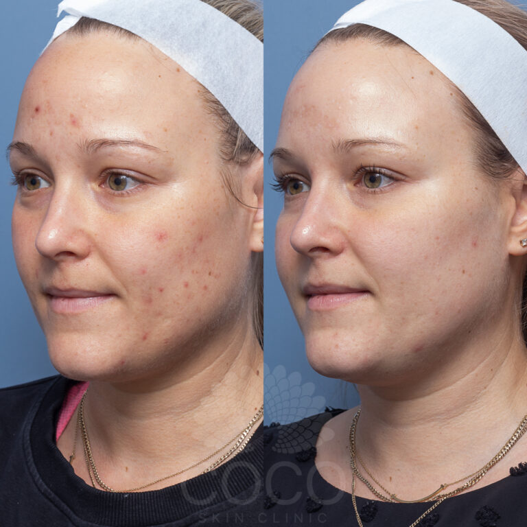 Nicole Bilman Enzyme Peel