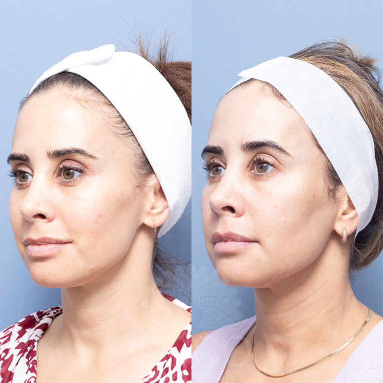 Power Peel Model