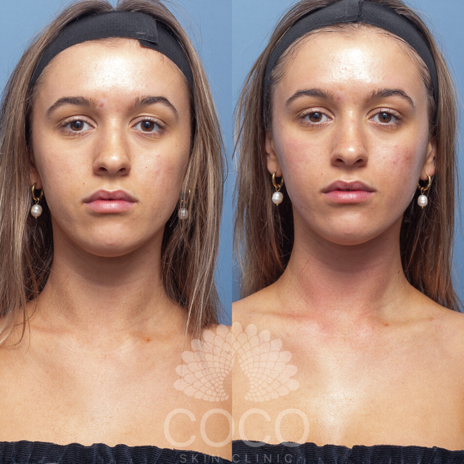 Medi Facial | Coco Skin Clinic