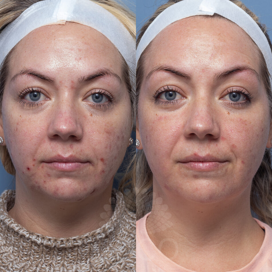 Forever clean | Coco Skin Clinic