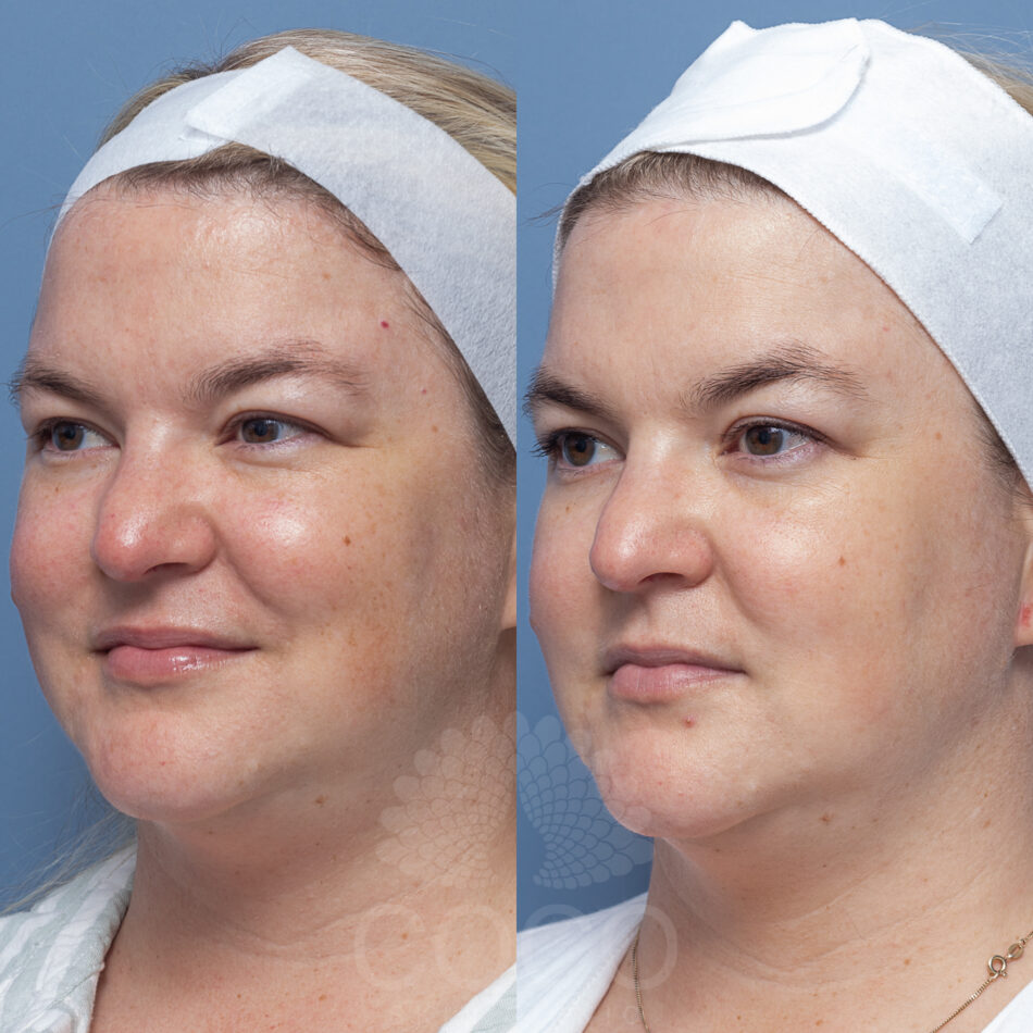 Light-based Treatment | BBL Skin Rejuvenation