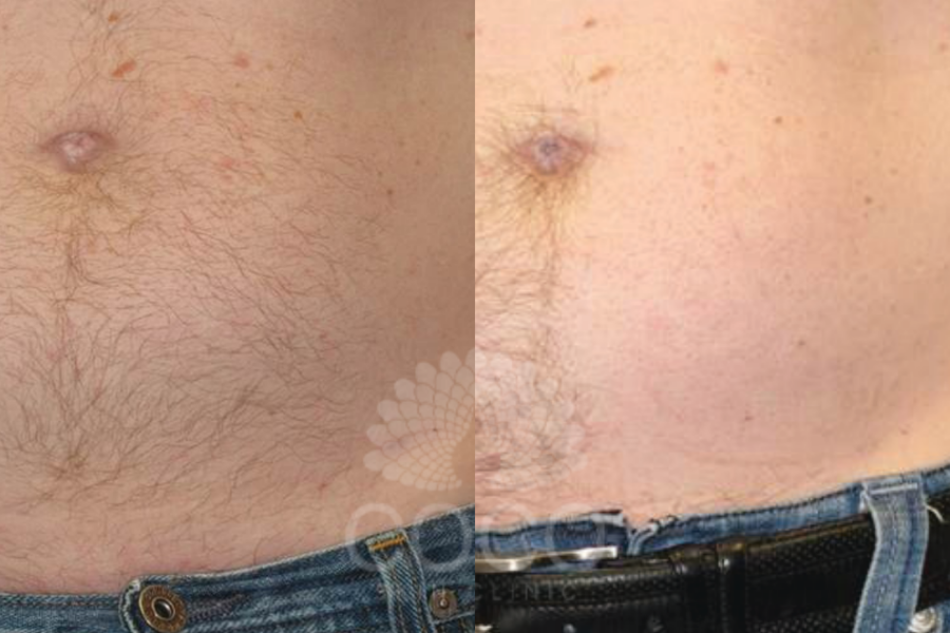 Forever Bare BBL™ | Coco Skin Clinic