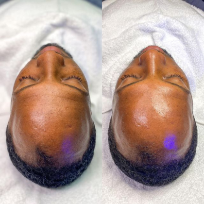 Radiant Skin | Hydrafacial