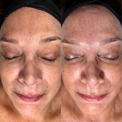 smoother skin texture after treatment