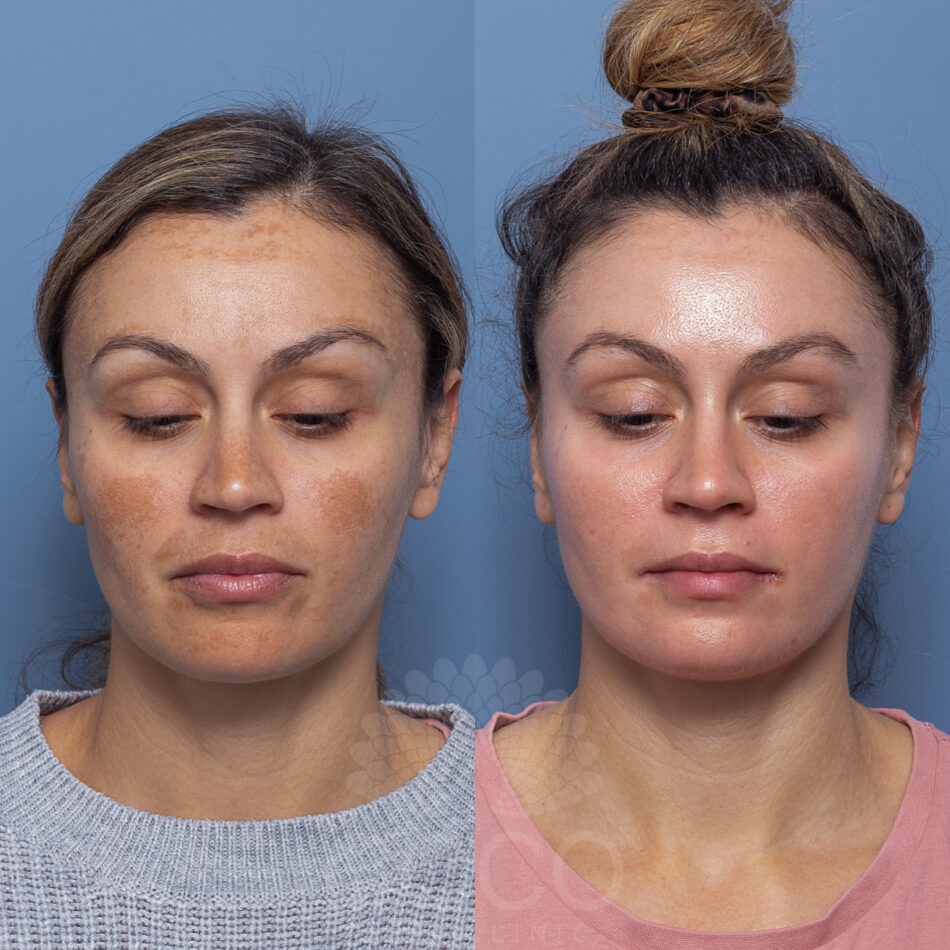 Pigmenting peel | Coco Skin Clinic