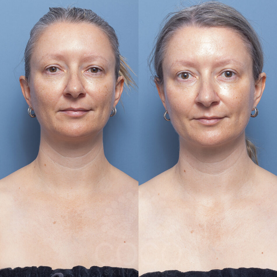 Combo BBL | Coco Skin Clinic