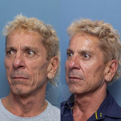 coco-skin-clinic-lines-wrinkles-before-after-02.jpg