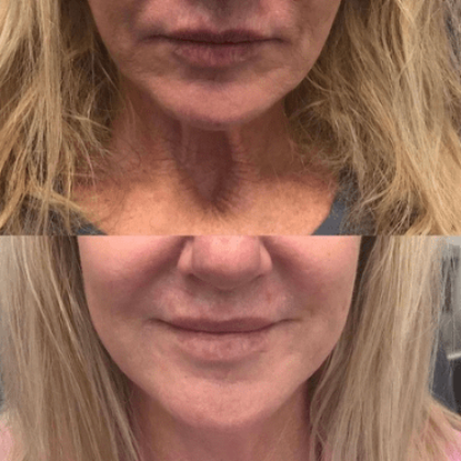 coco-skin-clinic-lines-wrinkles-before-after-03.jpg