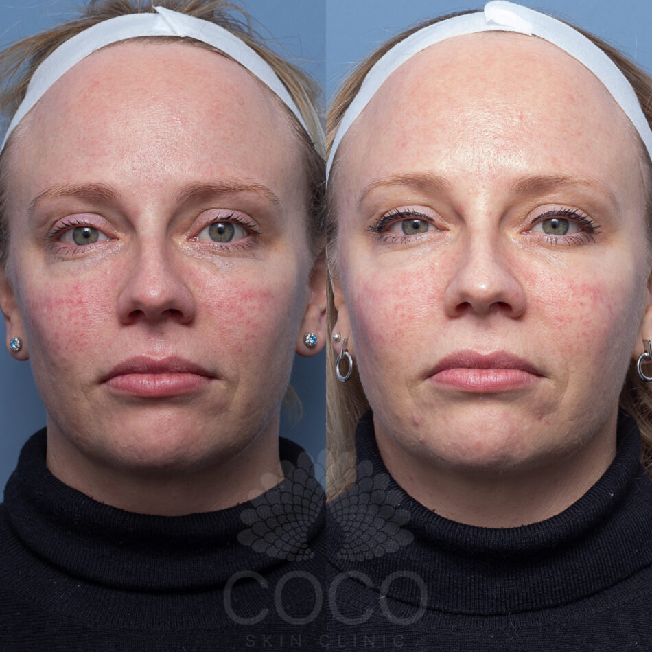 Skin result for Skin Rejuvenation | Coco Skin Clinic